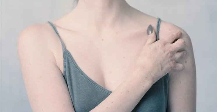 Scars